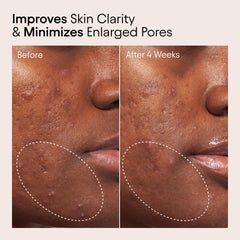 Alpyn Beauty Acido Salicílico 2%, exfoliación suave de poros.