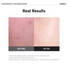 FRANKLY Niacinamida 15% + Zinc Serum, perlas encapsuladas, entrega fresca al contacto.