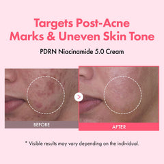 Aplicación diaria de TOSOWOONG PDRN Niacinamide 5% crema, textura ligera que se absorbe sin residuos.
