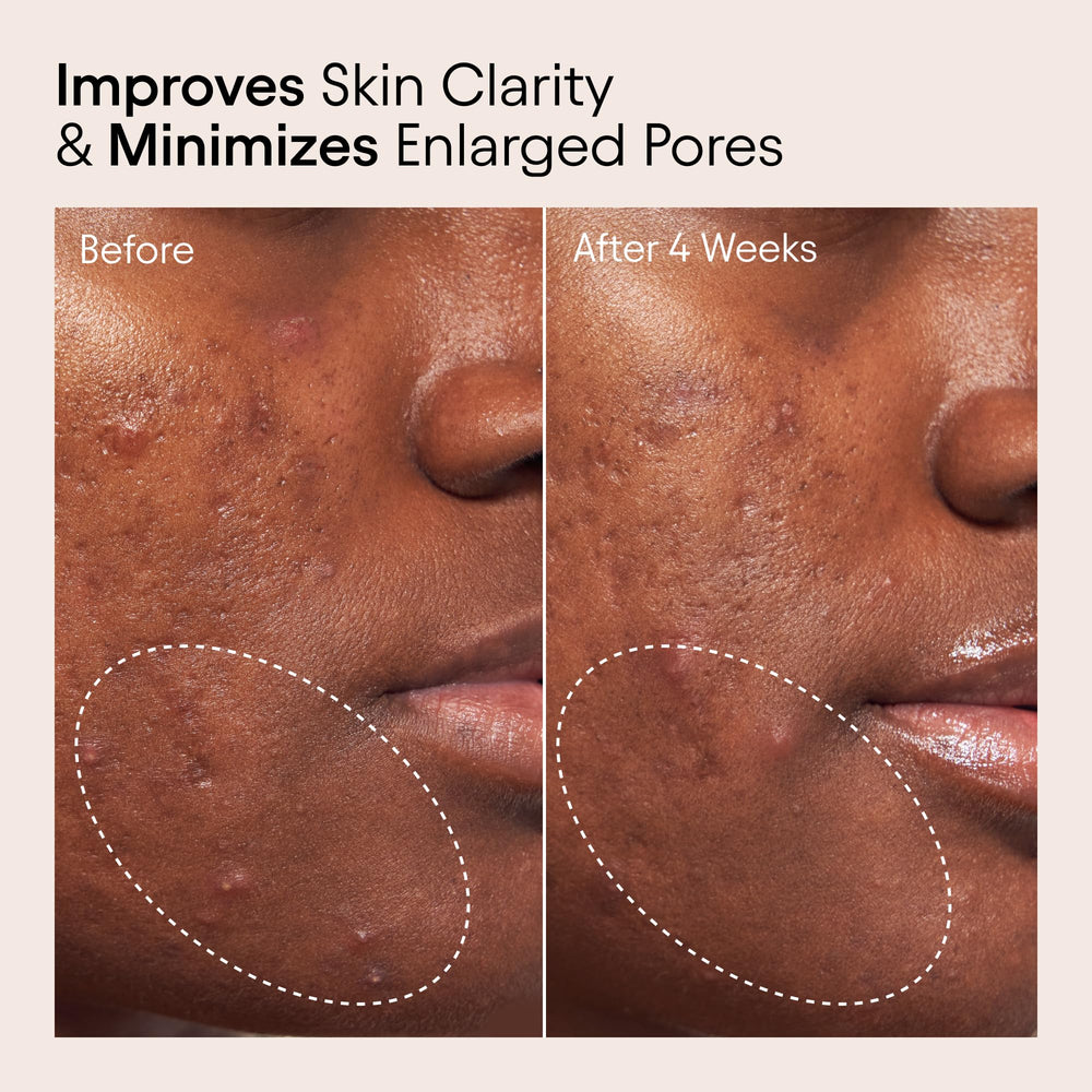 Alpyn Beauty Acido Salicílico 2%, exfoliación suave de poros.
