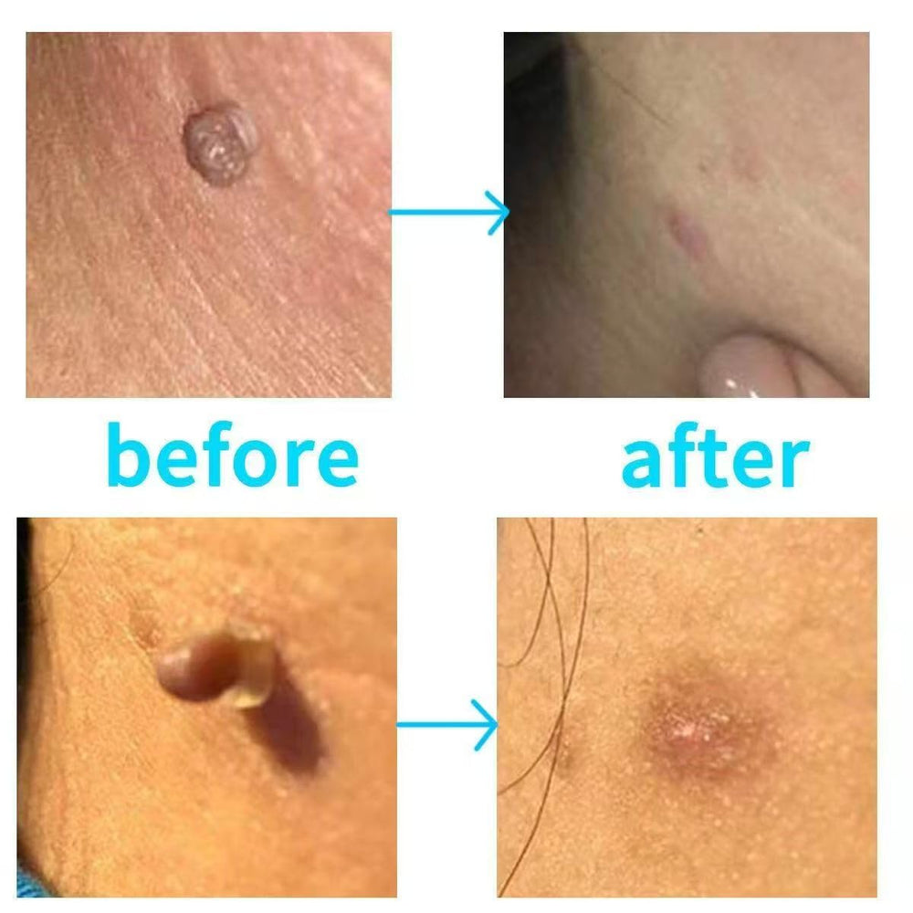 Aplicación suave y controlada en rostro con AOLUC Remover Verrugas.