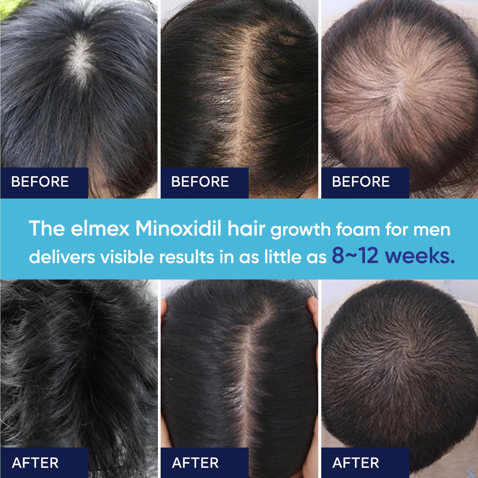 Cabello fino mostrado junto a Artimore Minoxidil 5% espuma para fortalecimiento.