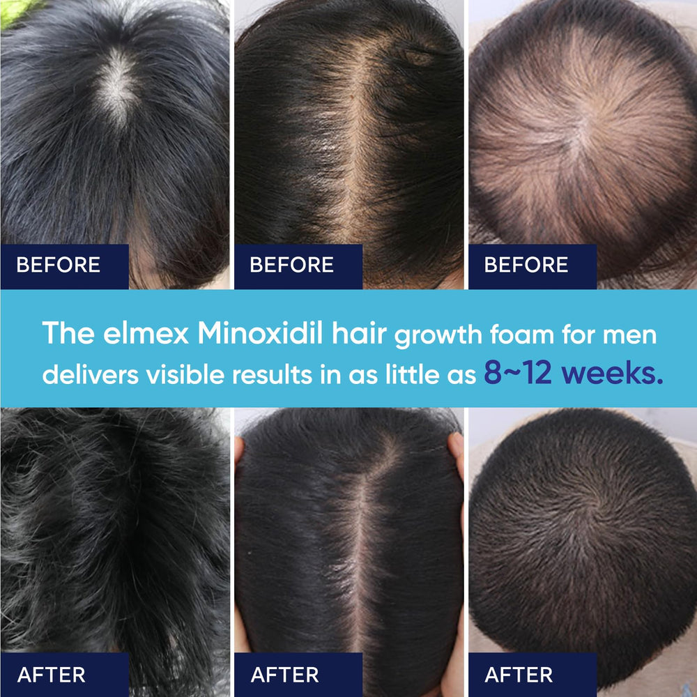 Mujeres pueden usar Artimore Minoxidil: cabello más volumen.