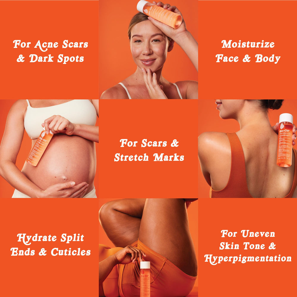 Bio-Oil ayuda a suavizar la apariencia de las estrías.