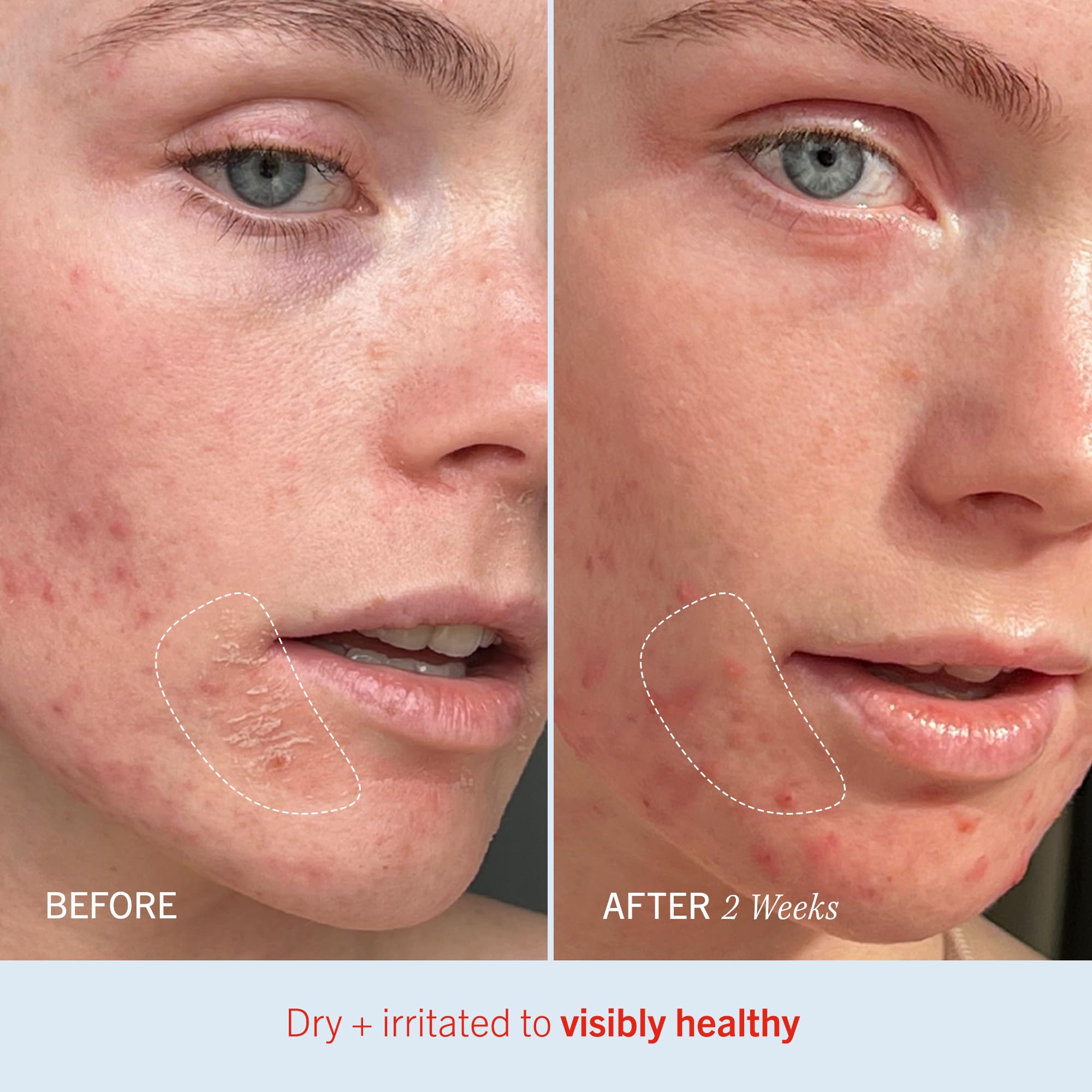Piel más suave tras usar First Aid Beauty Crema Ultra Repair.