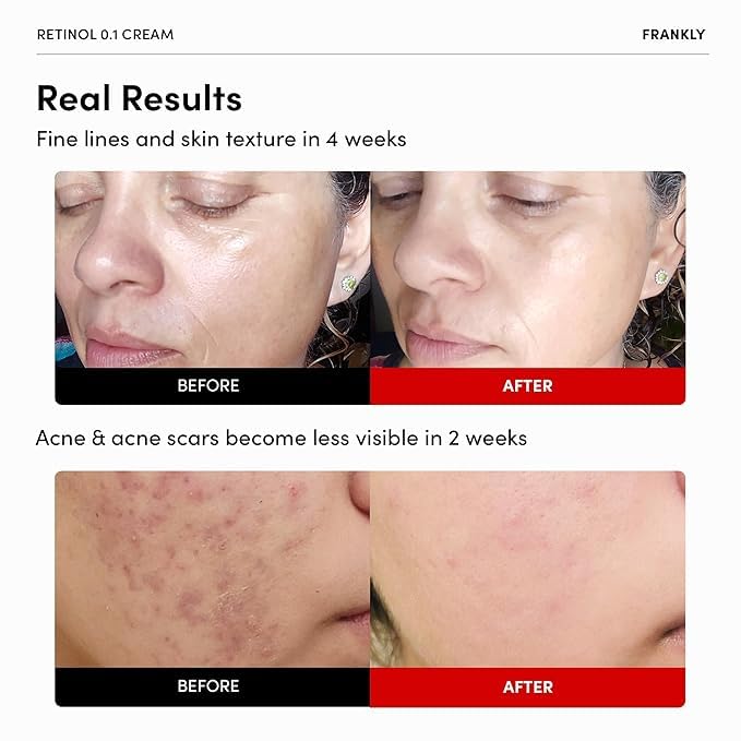 FRANKLY Retinol 0.1% crema, textura cremosa suave, facilita hidratación profunda.