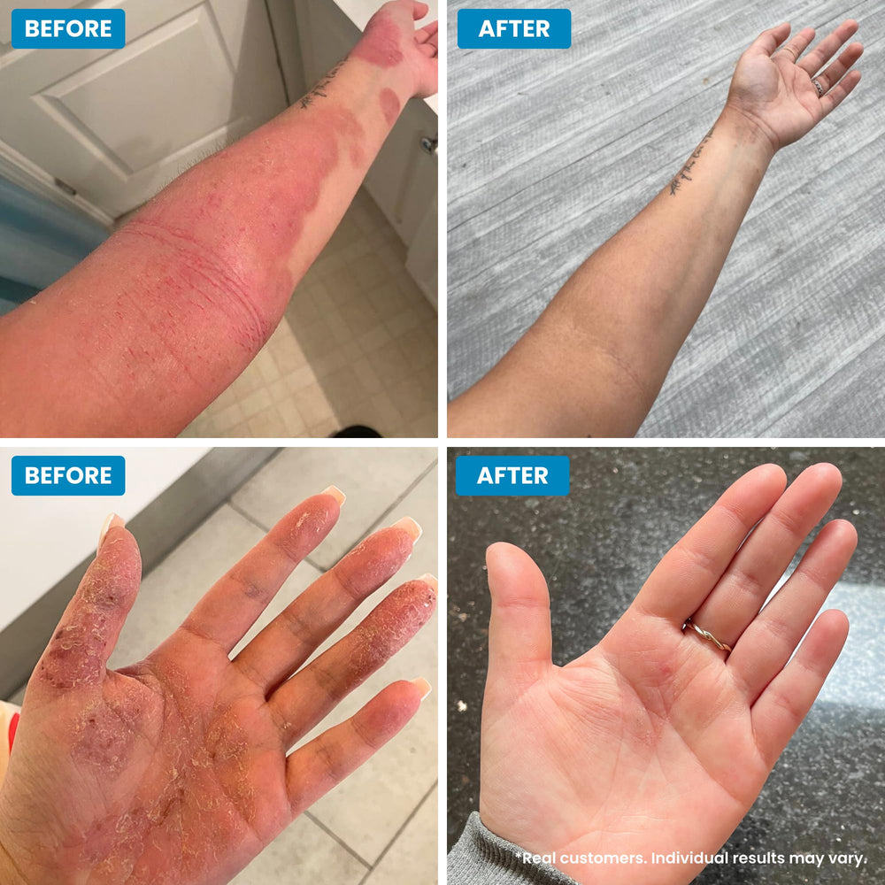 Grahams Natural C+ Crema eczema rostro: calma en áreas sensibles.