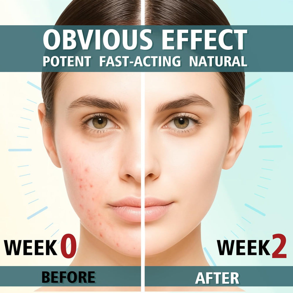 Aplicación de HORSEFISH TOOL crema acne en áreas propensas a brotes