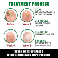 IMOLL Tratamiento de uñas con jengibre para nutrición diaria de la cutícula.