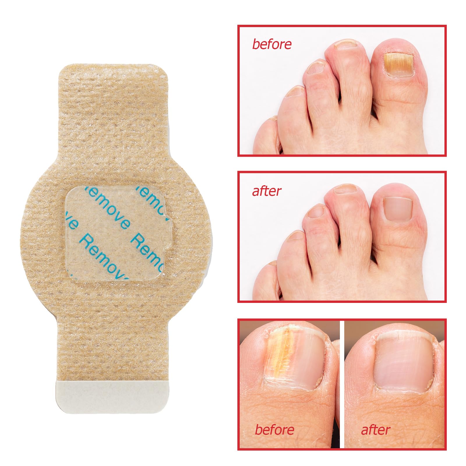 LTQXGT Fungal Nail Patches contents opened highlight 21 pieces for complete at-home treatment.