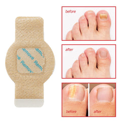 LTQXGT Fungal Nail Patches contents opened highlight 21 pieces for complete at-home treatment.