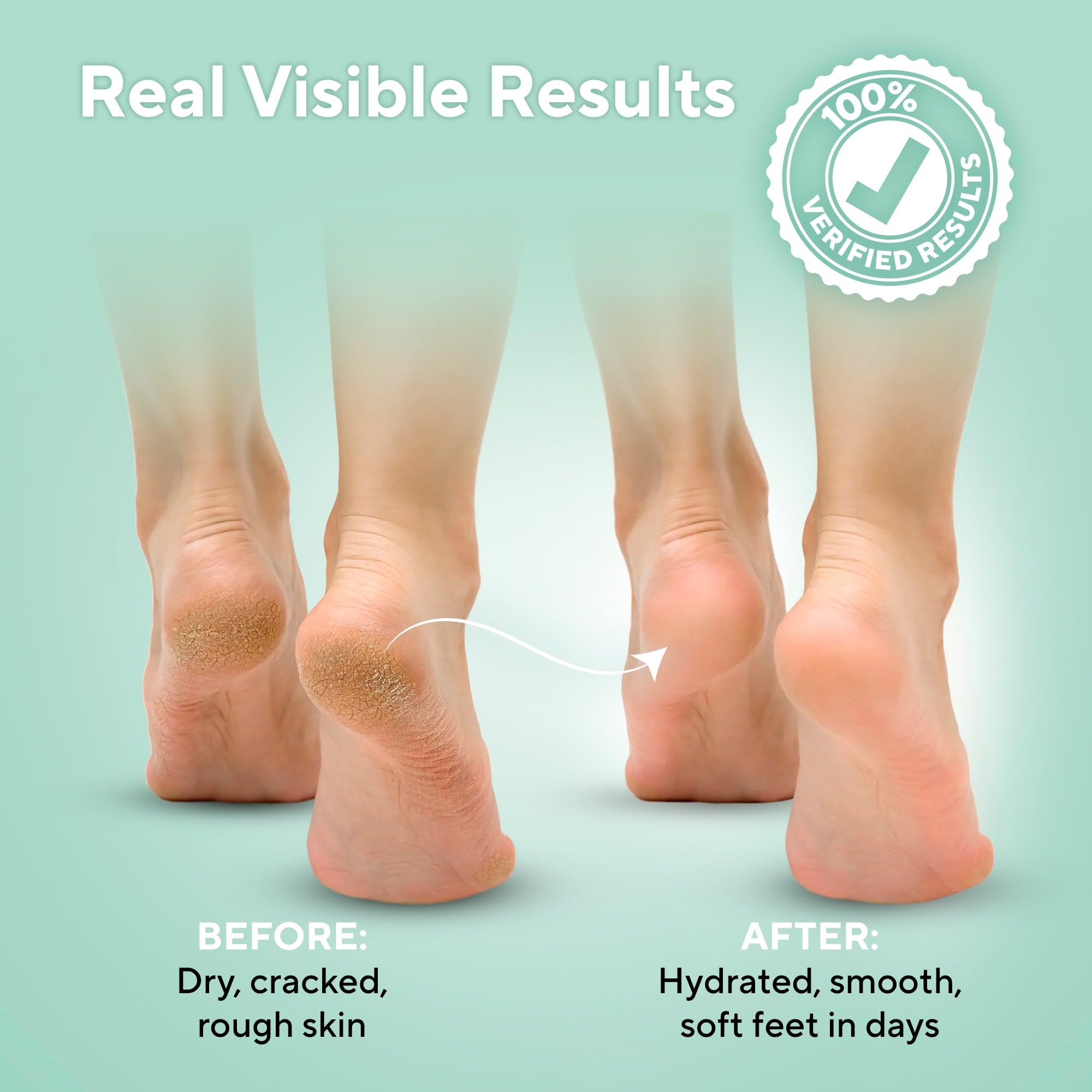 Lavinso Crema Urea 40% para Pies: piel hidratada y flexible.