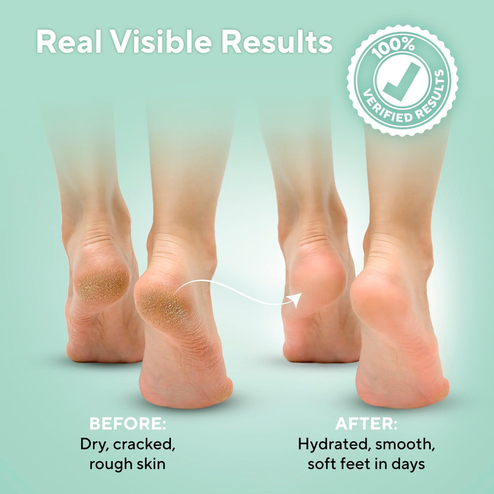 Lavinso Crema Urea 40% para Pies: piel hidratada y flexible.