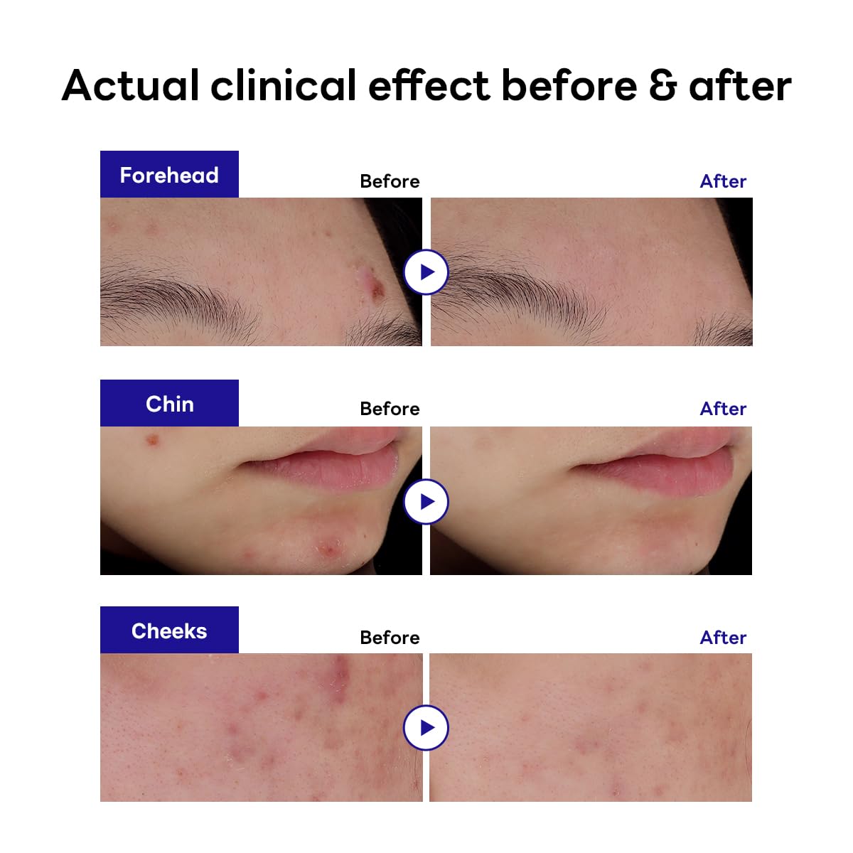 Parche hidrocoloide Mediheal Derma Clear mantiene humedad y absorbe exudado.