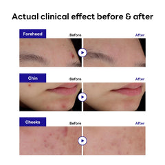 Parche hidrocoloide Mediheal Derma Clear mantiene humedad y absorbe exudado.