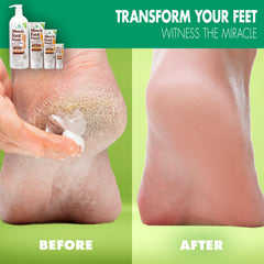 Milagro de Aloe reparación suave de pies para talones secos y agrietados.