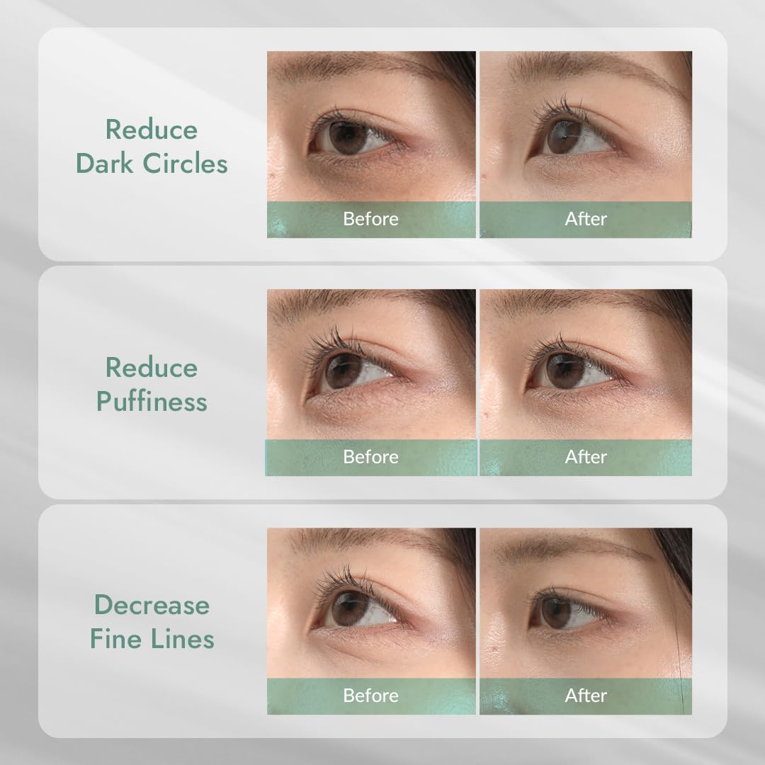 MIZON Cicaluronic ilumina la zona inferior con Vitamina K3 para aclarar ojeras.