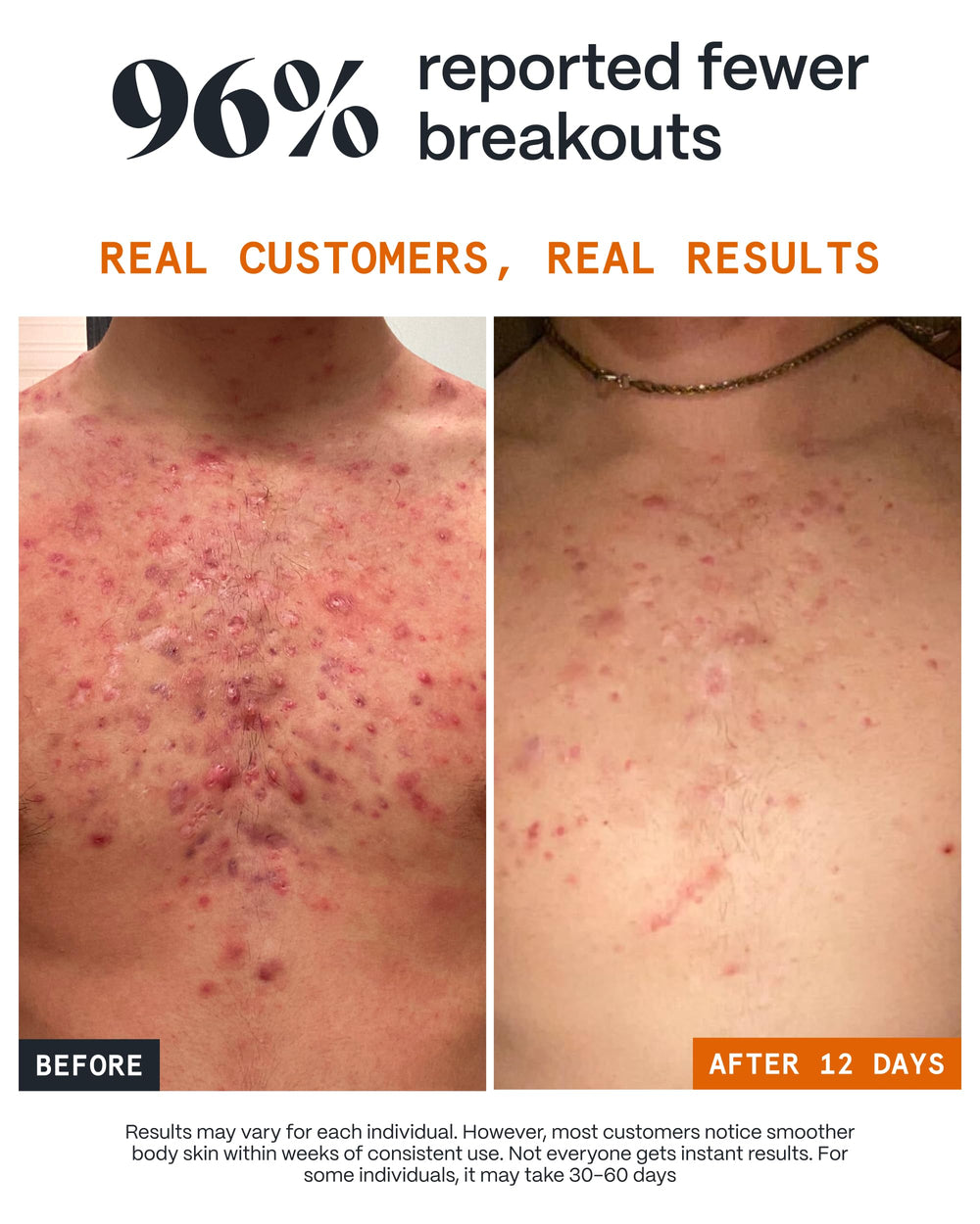 Bálsamo Norse Organics Acne Hombros, sensación suave tras la aplicación.