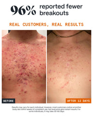 Bálsamo Norse Organics Acne Hombros, sensación suave tras la aplicación.