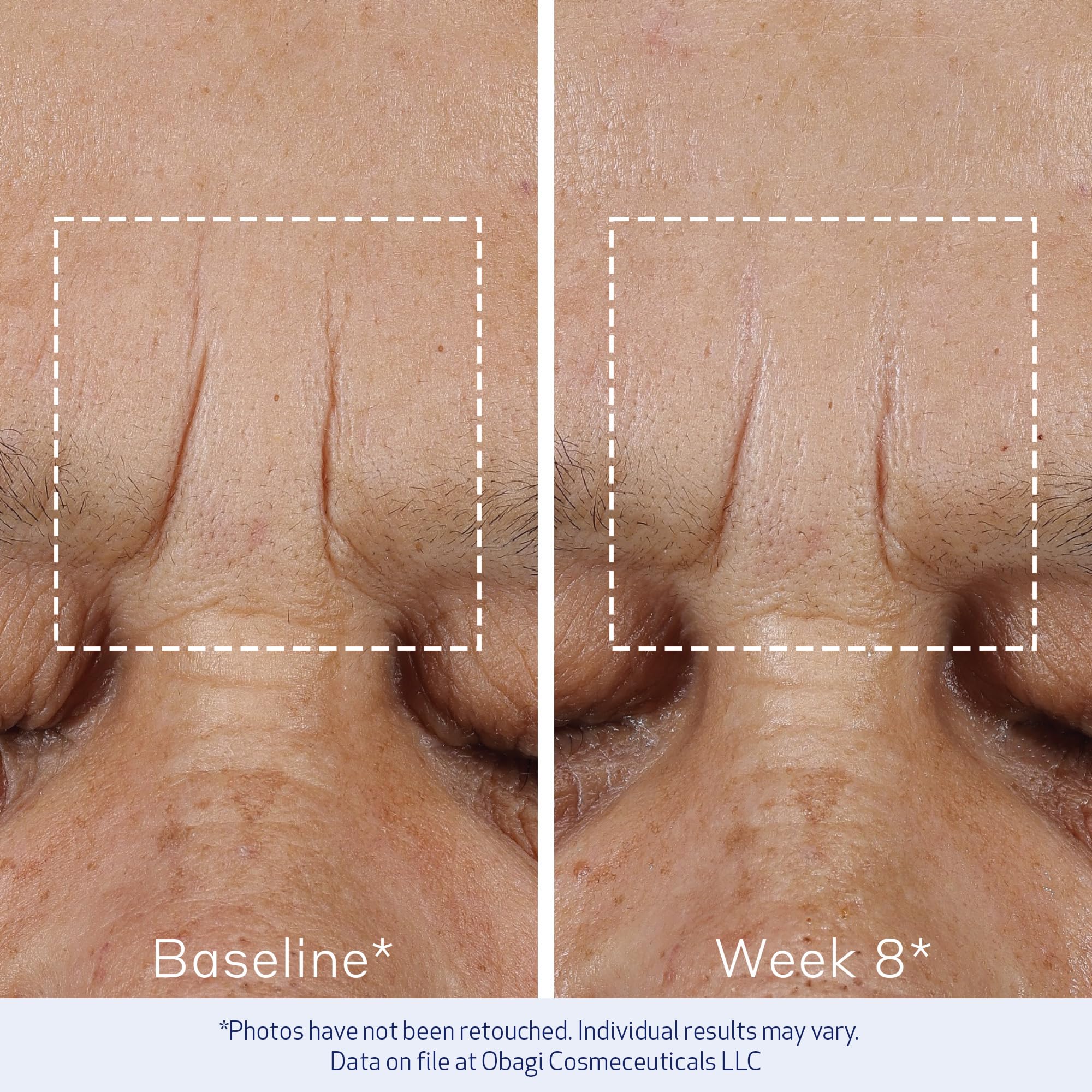 Obagi Elastiderm, estudio clínico con datos que respaldan mejoras de líneas finas.