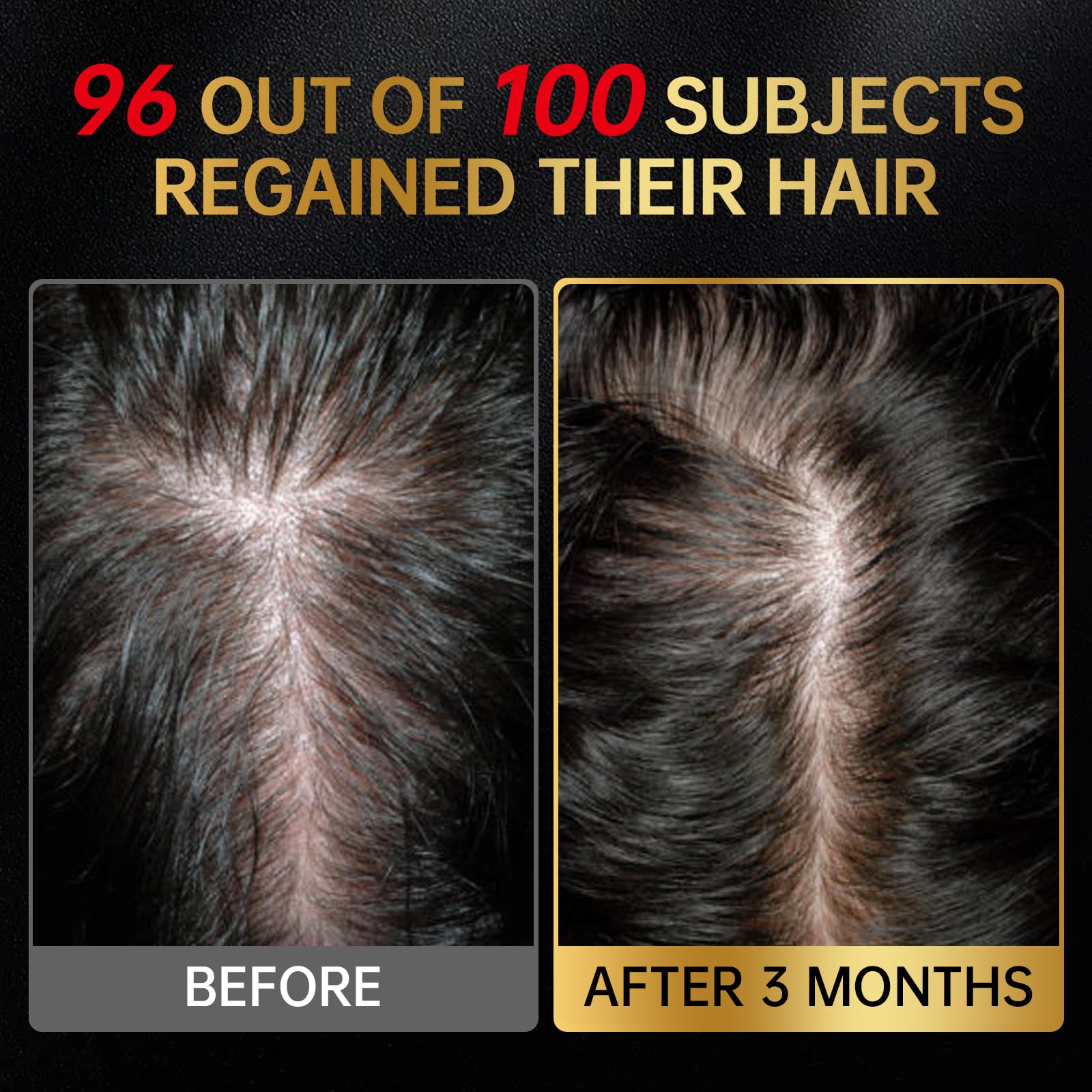 OCSINL Minoxidil biotina ingrediente clave para fortalecer cada hebra