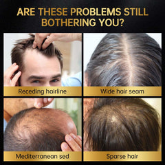 OCSINL Minoxidil gotero preciso para dosificación exacta y uso diario