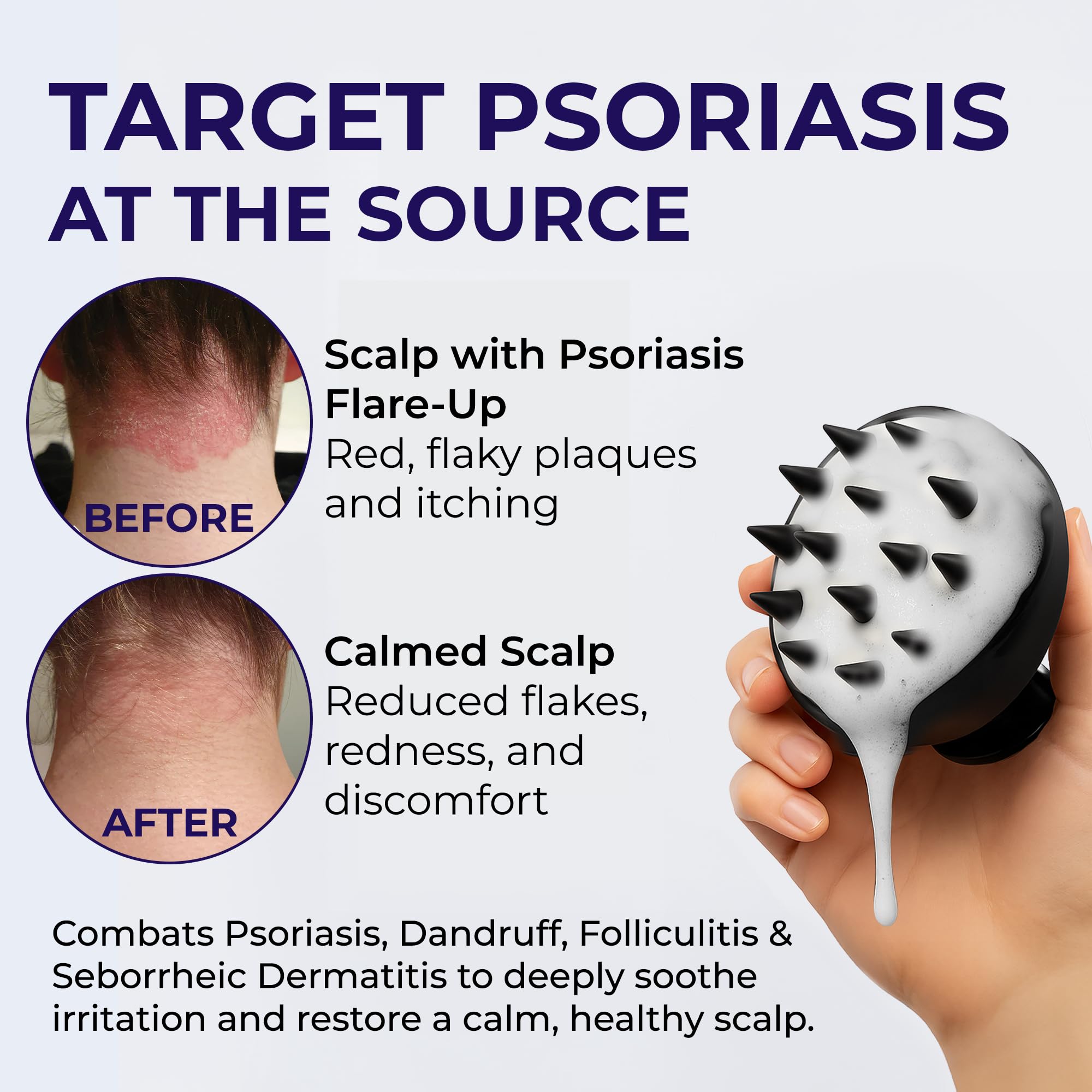 Aplicación en manos con Pharmlitalia Psoriasis Shampoo para iniciar la limpieza.