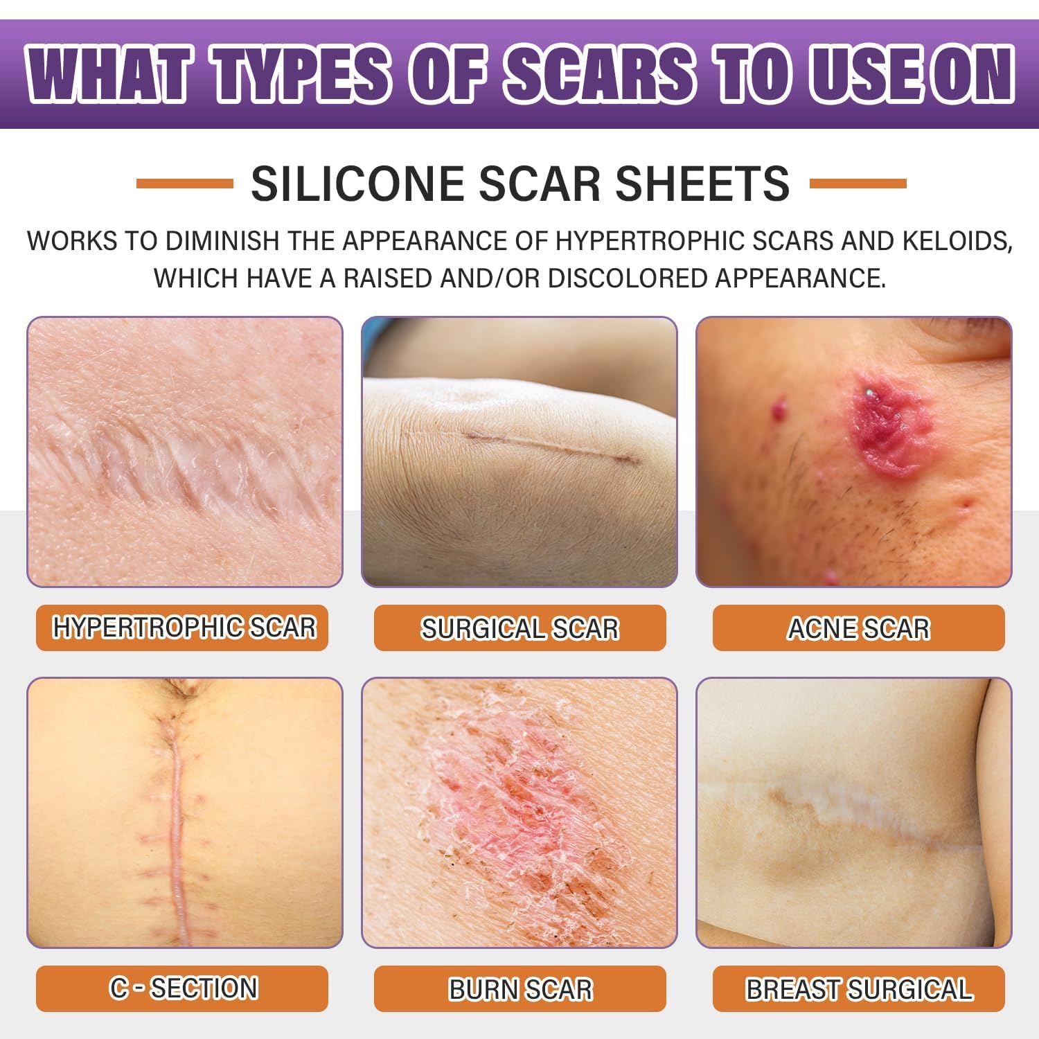 Psecici cinta silicona cicatriz adhesión discreta para cirugías.