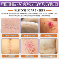 Psecici cinta silicona cicatriz adhesión discreta para cirugías.