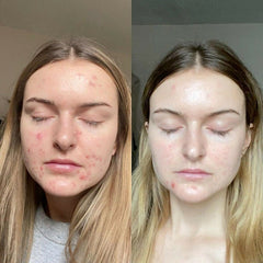 Retinol Gel 0,1% – aplicación nocturna para textura uniforme.