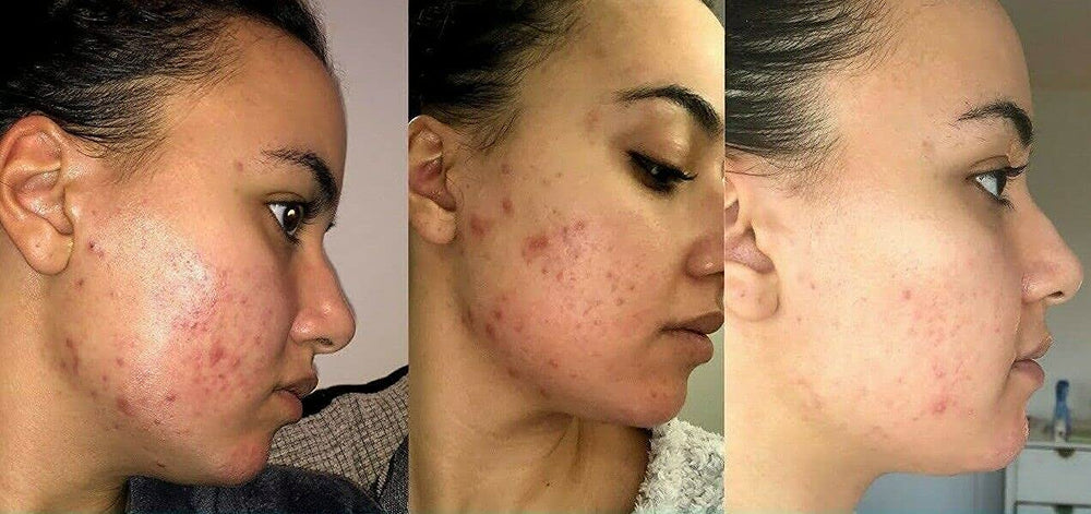 Retinol Gel 0,1% – resultado de piel más suave y uniforme.