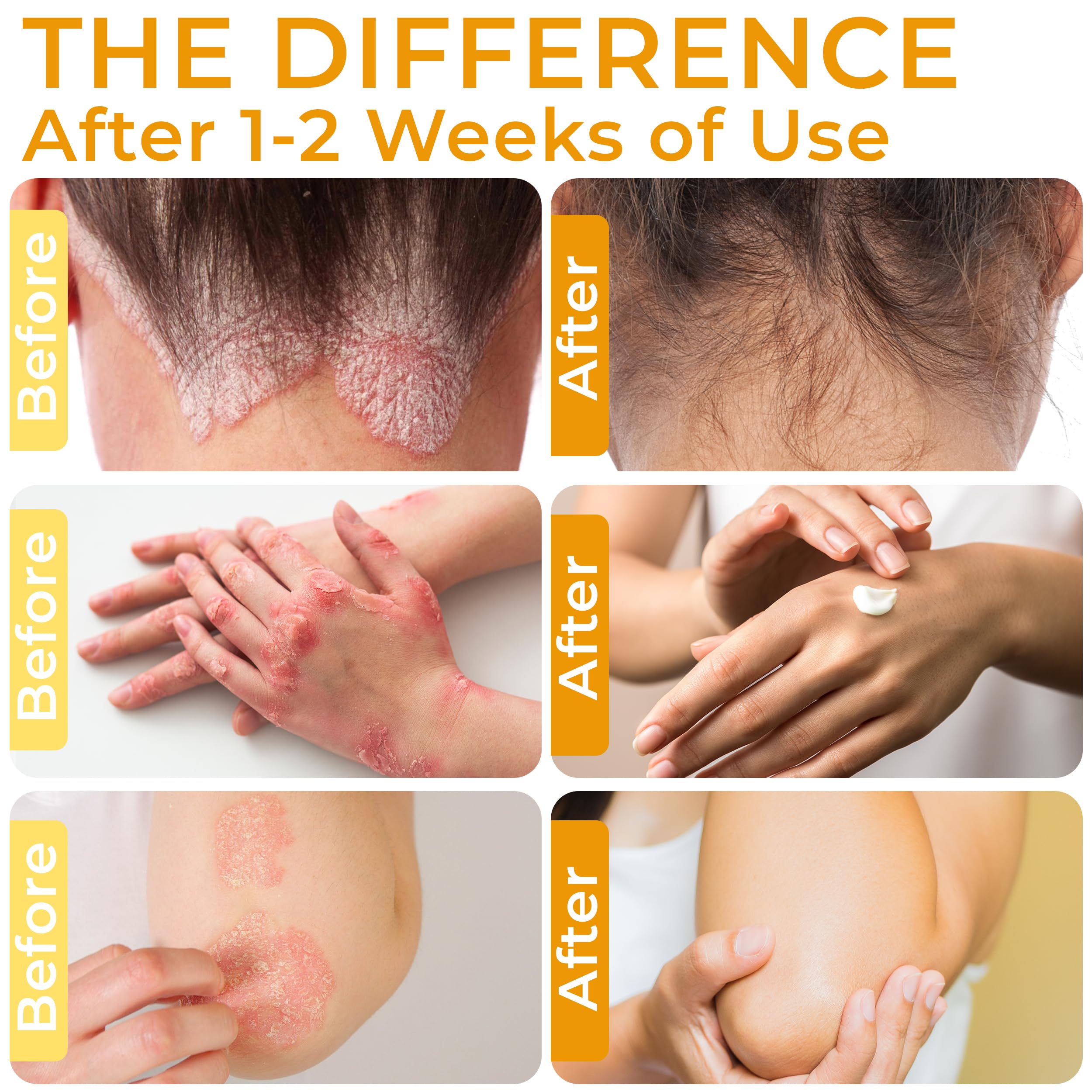 Rida Hair Research Institute: crema psoriasis para el cuerpo, hidratación suave y alivio diario.
