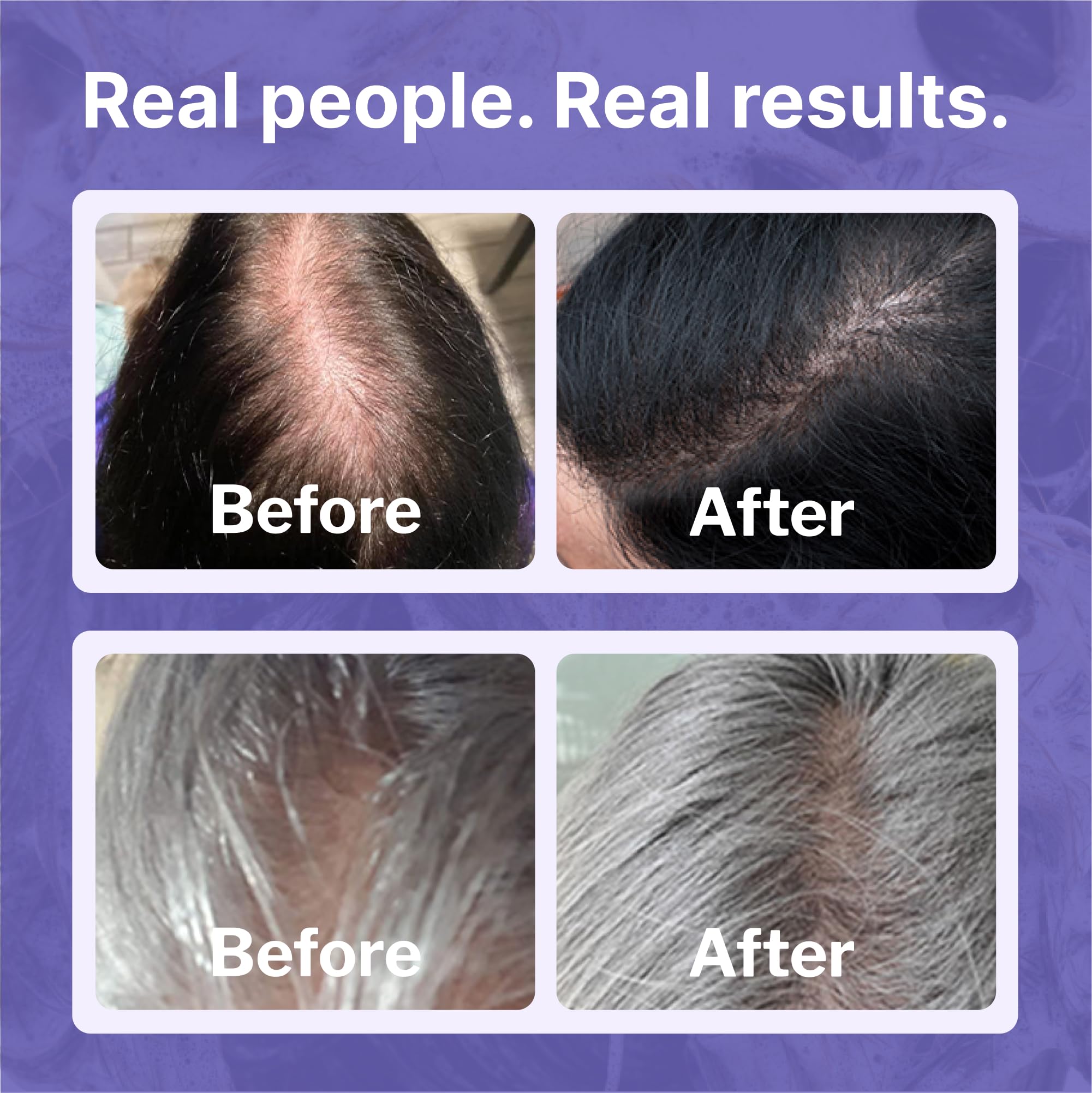 Mujer con cabello más denso gracias a Shapiro MD Minoxidil 2%