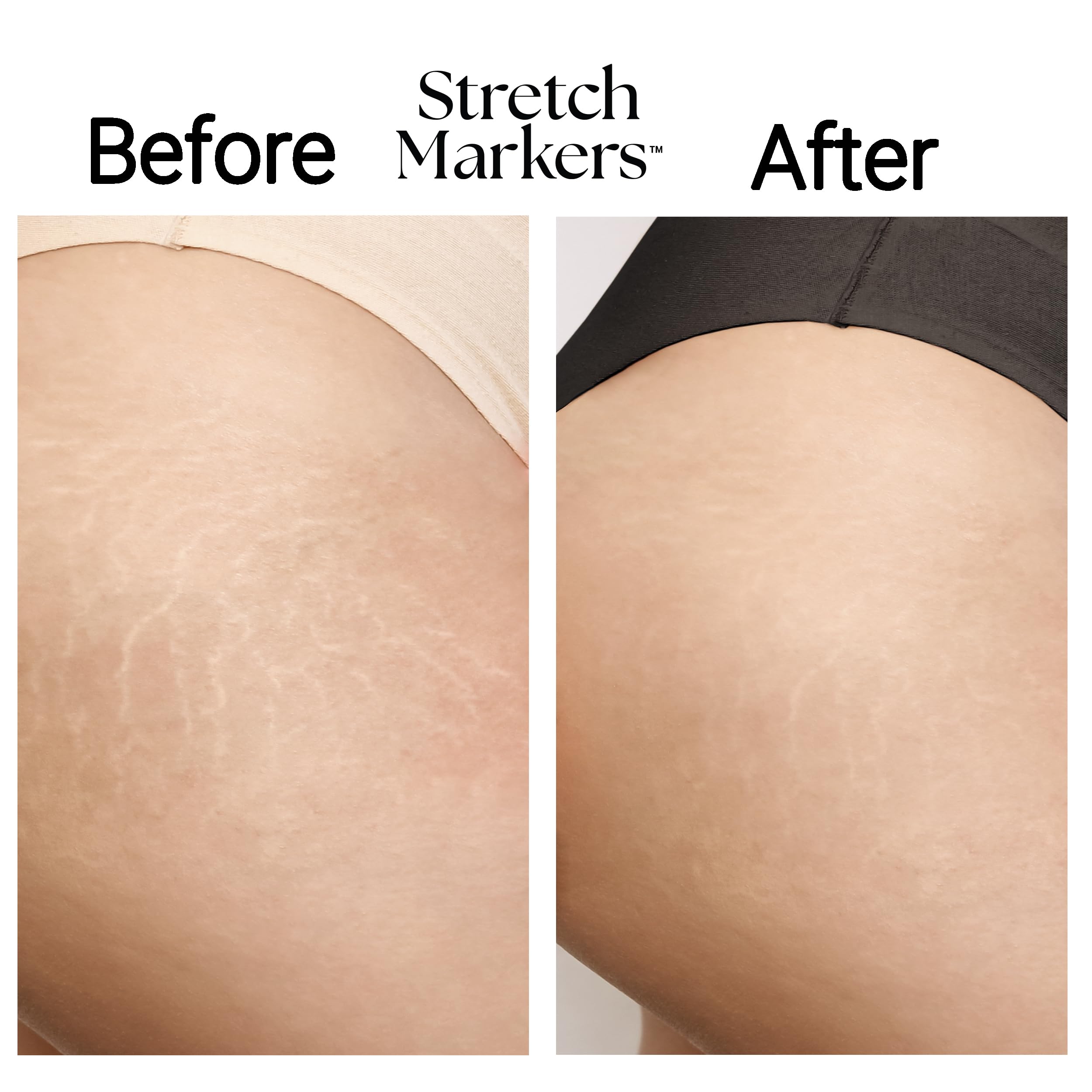 StretchMarkers Terapia utiliza tecnología de células madre 3D para rejuvenecer la piel.
