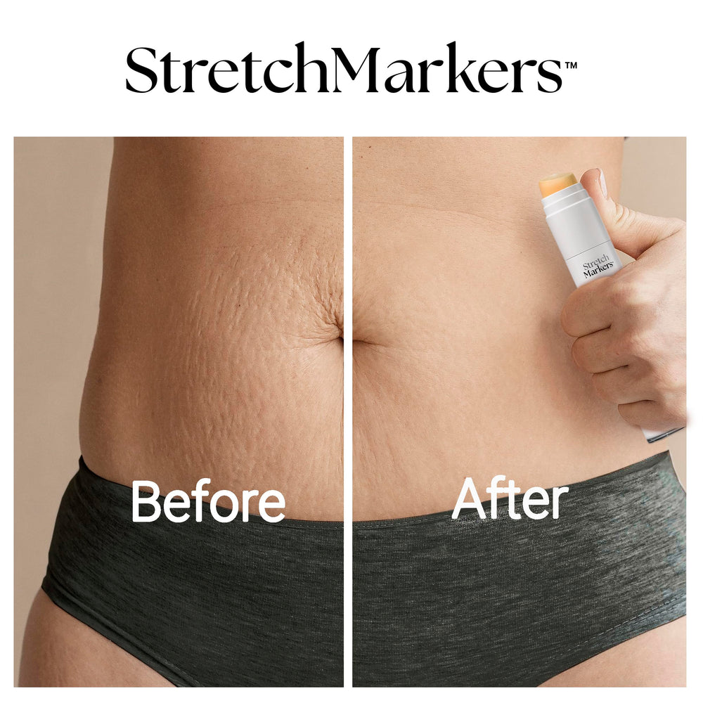 StretchMarkers Terapia es ideal tras el embarazo para abordar estrías y elasticidad de la piel.