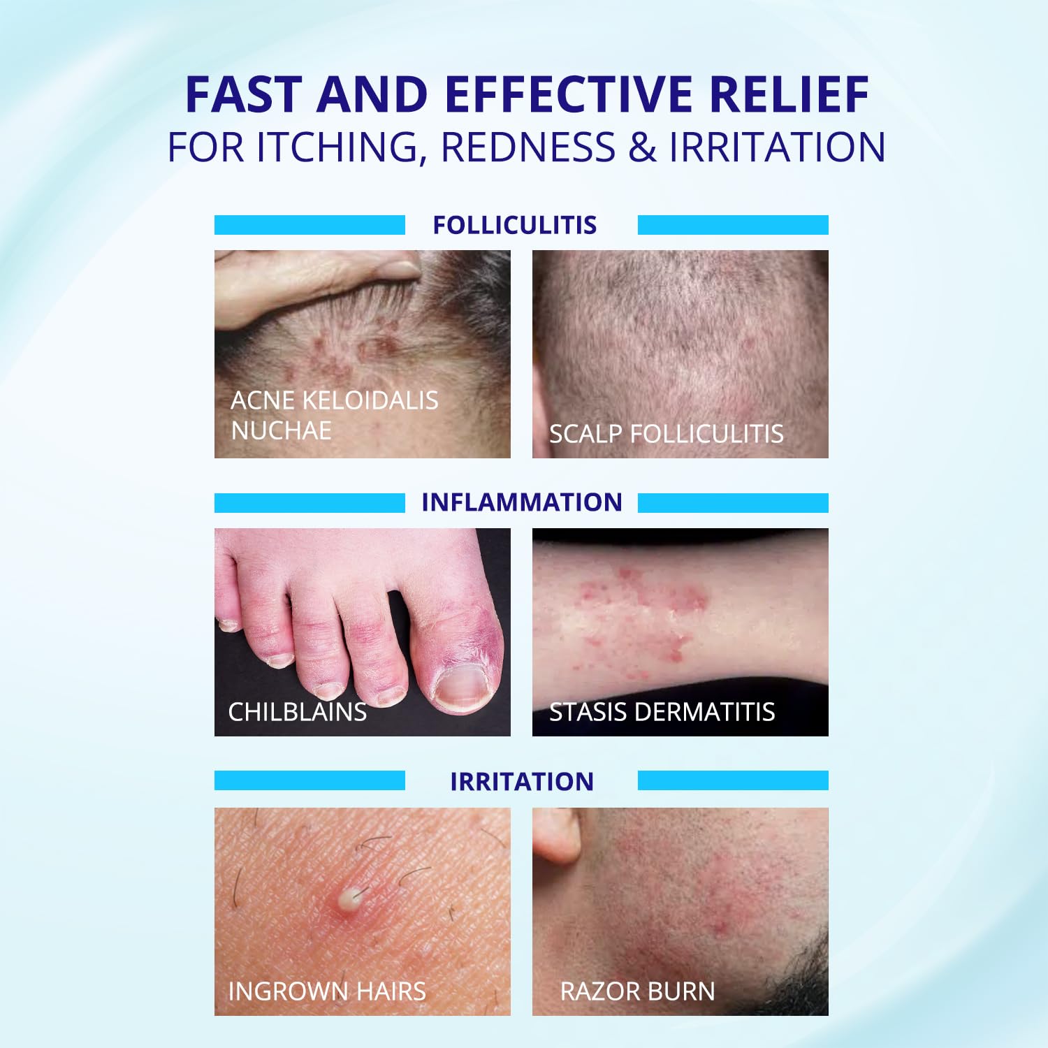 TAGRID Crema Foliculitis, alivio inmediato y confort de piel tras uso breve