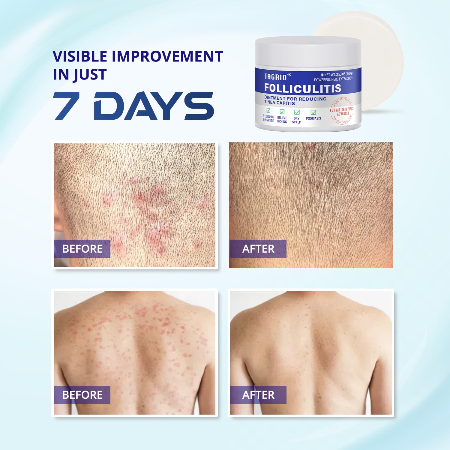 TAGRID Crema Foliculitis, para rostro y cuerpo con absorción rápida