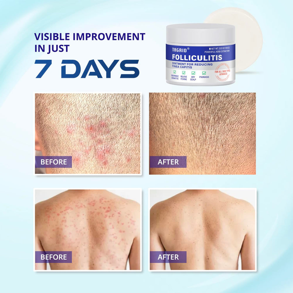 TAGRID Crema Foliculitis, para rostro y cuerpo con absorción rápida