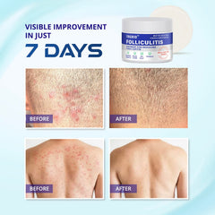 TAGRID Crema Foliculitis, para rostro y cuerpo con absorción rápida