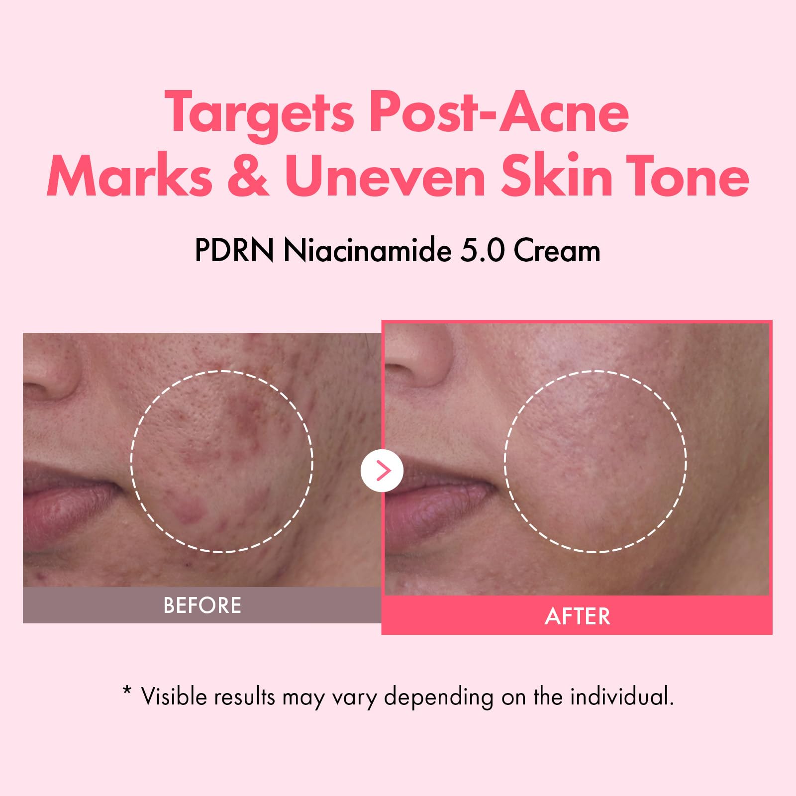 Aplicación diaria de TOSOWOONG PDRN Niacinamide 5% crema, textura ligera que se absorbe sin residuos.