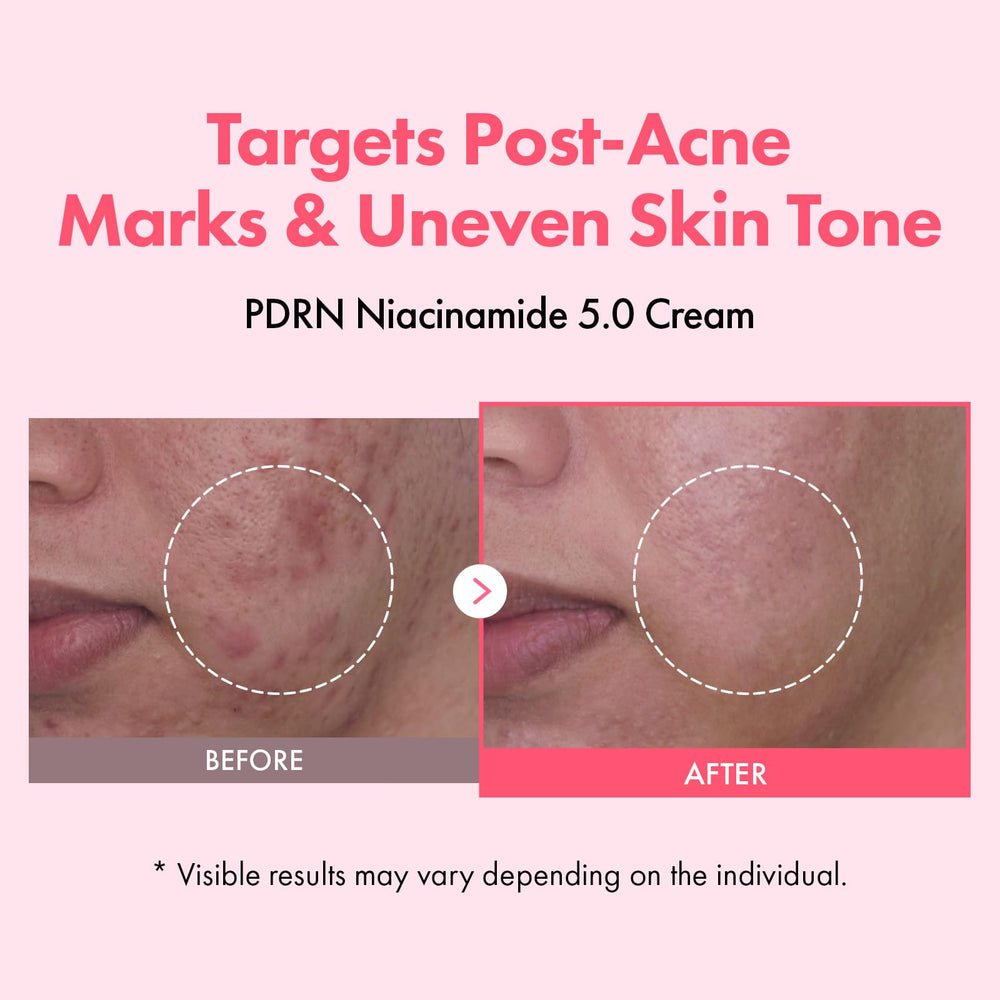 Aplicación diaria de TOSOWOONG PDRN Niacinamide 5% crema, textura ligera que se absorbe sin residuos.