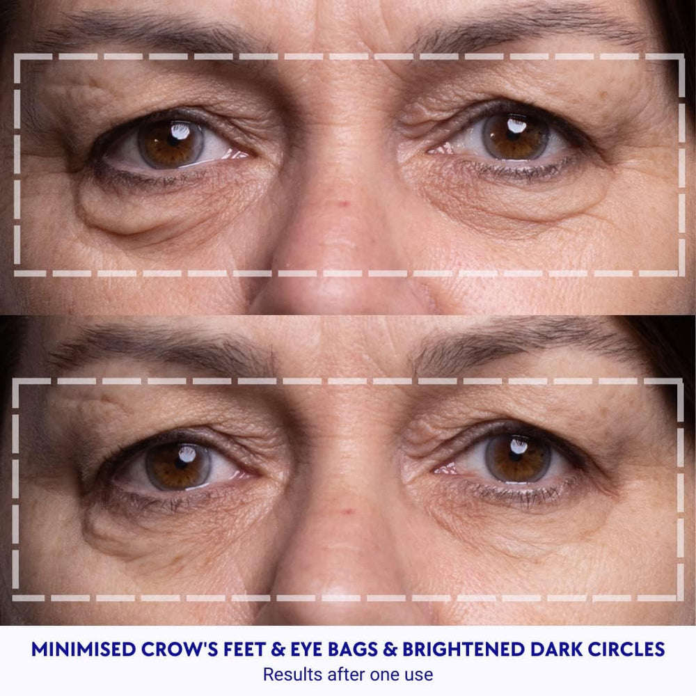 Wrinkles Schminkles parches ojos-ojeras: reducen sombras visibles durante la noche