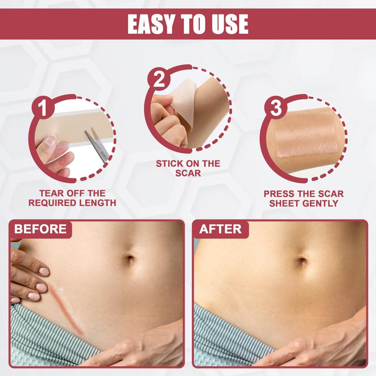 Cinta de silicona WROLY para cicatriz queloide: ayuda a suavizar el relieve con uso regular