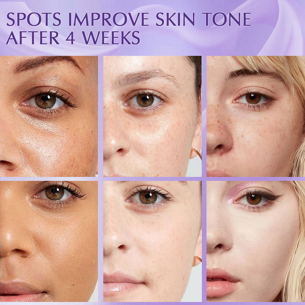 YRNVK Tratamiento de melasma con mejoras visibles