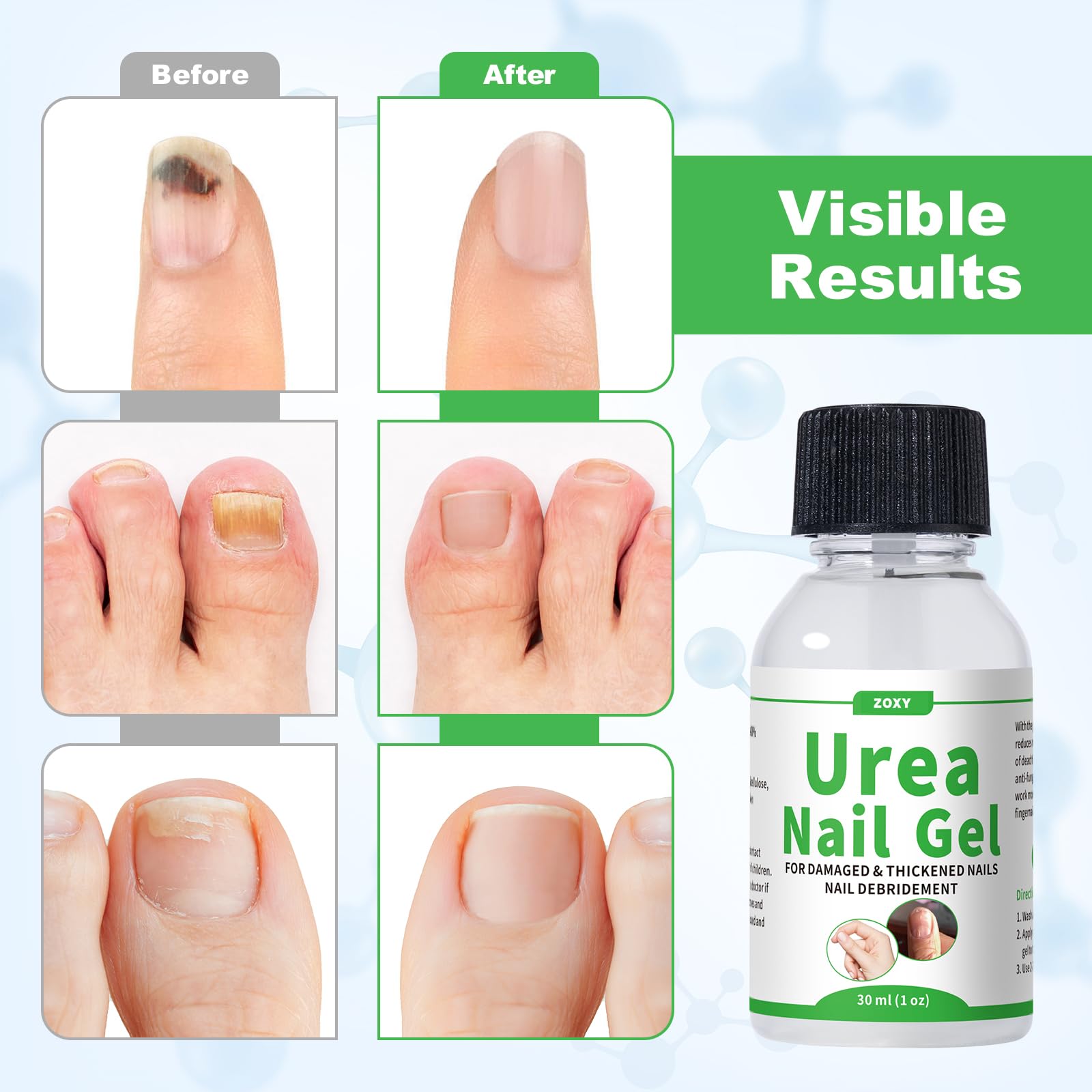 ZOXY 50% gel de urea para uñas, enfoque en uñas gruesas y callos en planta